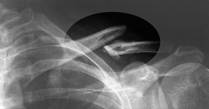 Photo322.jpg - Fracture de la clavicule.
A opérer selon le chirurgien de Bourg-en-Bresse,
ne rien faire selon le chirurgien Genevois.